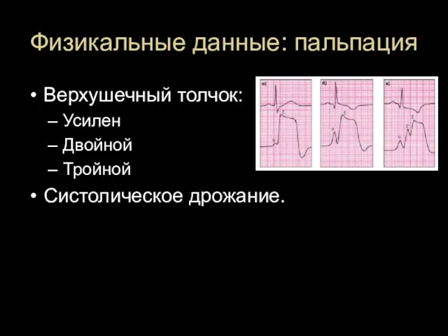 Физикальные данные: пальпация Верхушечный толчок: Усилен Двойной Тройной Систолическое дрожание.