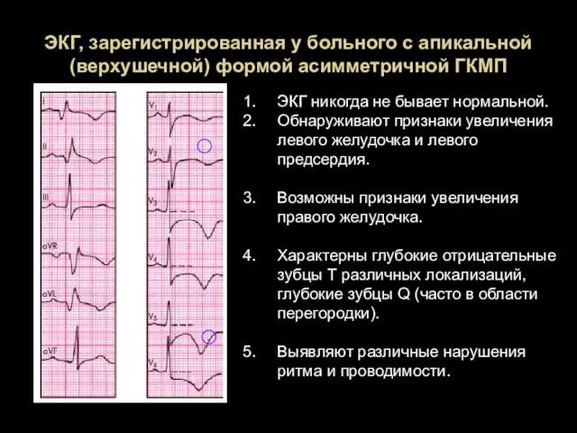 ЭКГ, зарегистрированная у больного с апикальной (верхушечной) формой асимметричной ГКМП ЭКГ