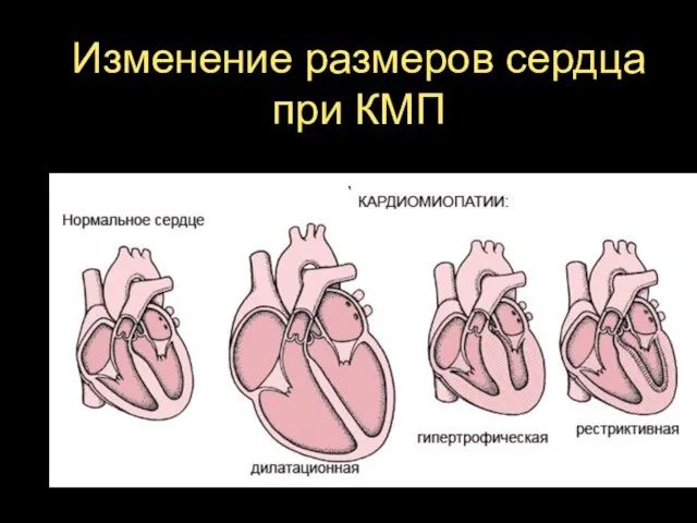 Изменение размеров сердца при КМП