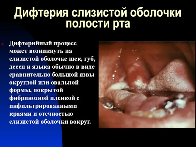Дифтерия слизистой оболочки полости рта Дифтерийный процесс может возникнуть на слизистой