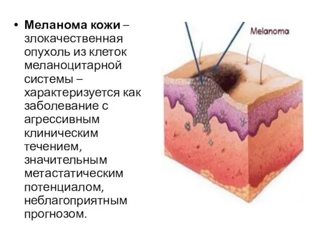 Меланома кожи – злокачественная опухоль из клеток меланоцитарной системы – характеризуется