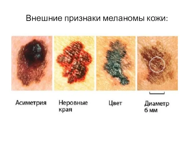 Внешние признаки меланомы кожи: