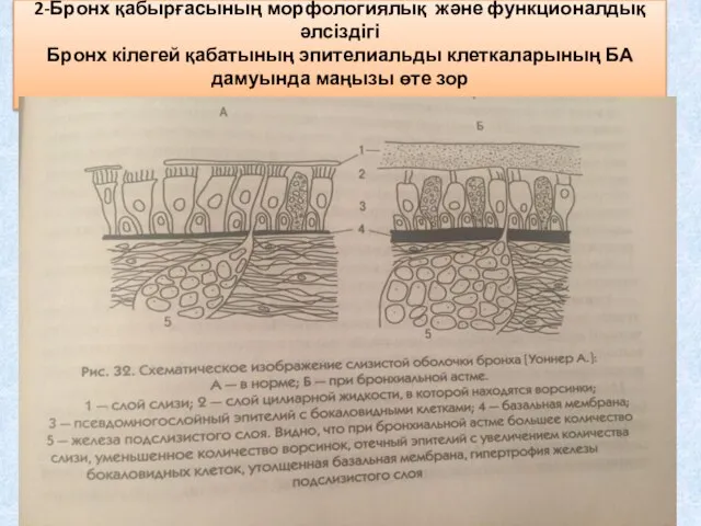 2-Бронх қабырғасының морфологиялық және функционалдық әлсіздігі Бронх кілегей қабатының эпителиальды клеткаларының БА дамуында маңызы өте зор