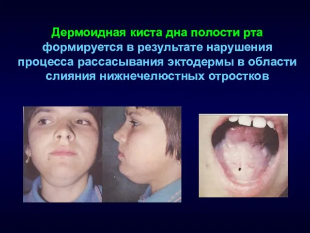 Дермоидная киста дна полости рта формируется в результате нарушения процесса рассасывания