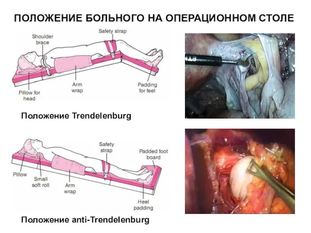 Положение anti-Trendelenburg Положение Trendelenburg ПОЛОЖЕНИЕ БОЛЬНОГО НА ОПЕРАЦИОННОМ СТОЛЕ