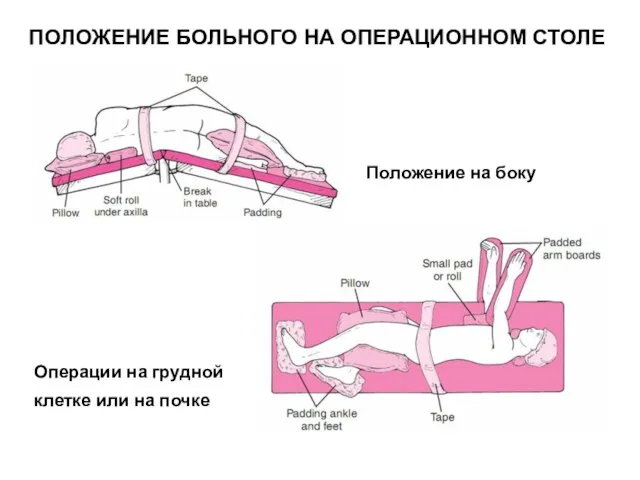 Положение на боку Операции на грудной клетке или на почке ПОЛОЖЕНИЕ БОЛЬНОГО НА ОПЕРАЦИОННОМ СТОЛЕ