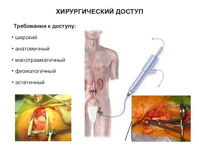 Требования к доступу: широкий анатомичный малотравматичный физиологичный эстетичный ХИРУРГИЧЕСКИЙ ДОСТУП