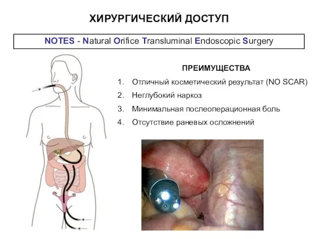 NOTES - Natural Orifice Transluminal Endoscopic Surgery ПРЕИМУЩЕСТВА Отличный косметический результат