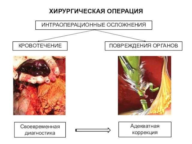 ИНТРАОПЕРАЦИОННЫЕ ОСЛОЖНЕНИЯ КРОВОТЕЧЕНИЕ ПОВРЕЖДЕНИЯ ОРГАНОВ Адекватная коррекция Своевременная диагностика ХИРУРГИЧЕСКАЯ ОПЕРАЦИЯ