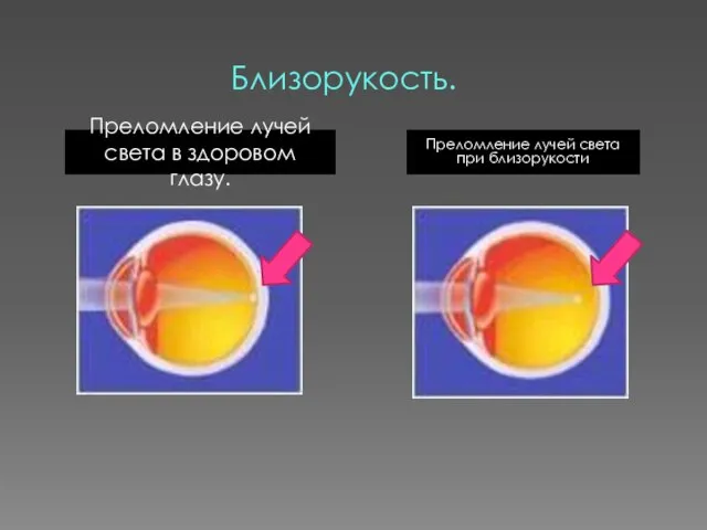 Близорукость. Преломление лучей света в здоровом глазу. Преломление лучей света при близорукости