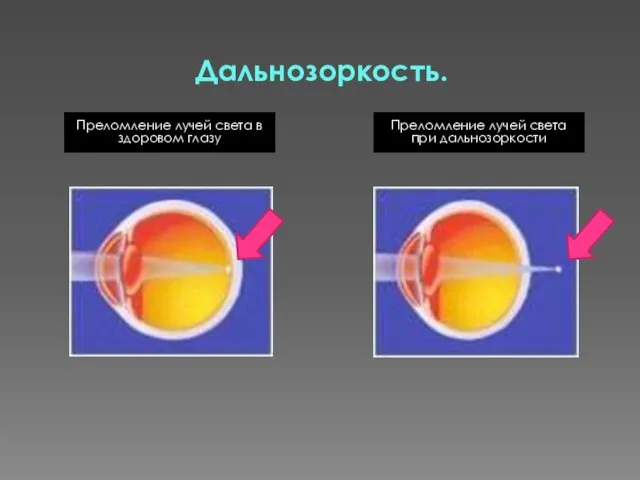 Дальнозоркость. Преломление лучей света в здоровом глазу Преломление лучей света при дальнозоркости