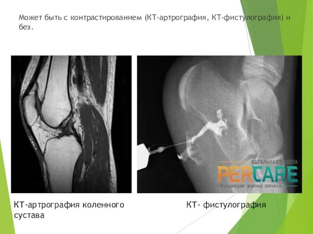 Может быть с контрастированием (КТ-артрография, КТ-фистулография) и без. КТ- фистулография КТ-артрография коленного сустава