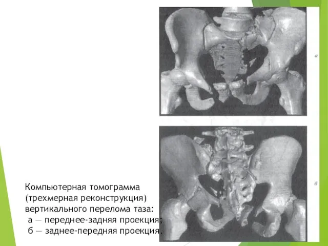 Компьютерная томограмма (трехмерная реконструкция) вертикального перелома таза: а — переднее-задняя проекция; б — заднее-передняя проекция.
