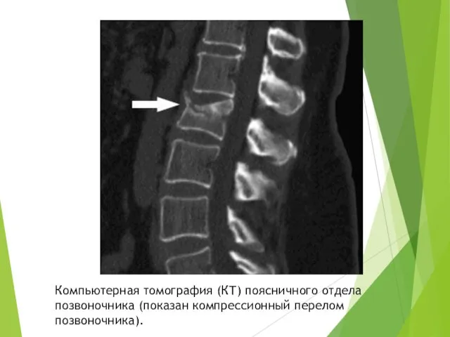 Компьютерная томография (КТ) поясничного отдела позвоночника (показан компрессионный перелом позвоночника).