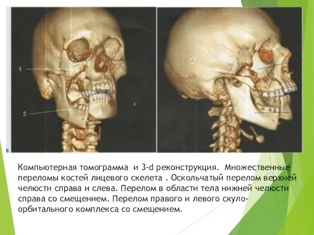 Компьютерная томограмма и 3-d реконструкция. Множественные переломы костей лицевого скелета .