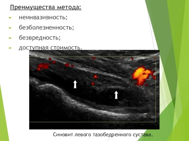 Преимущества метода: неинвазивность; безболезненность; безвредность; доступная стоимость. Синовит левого тазобедренного сустава.