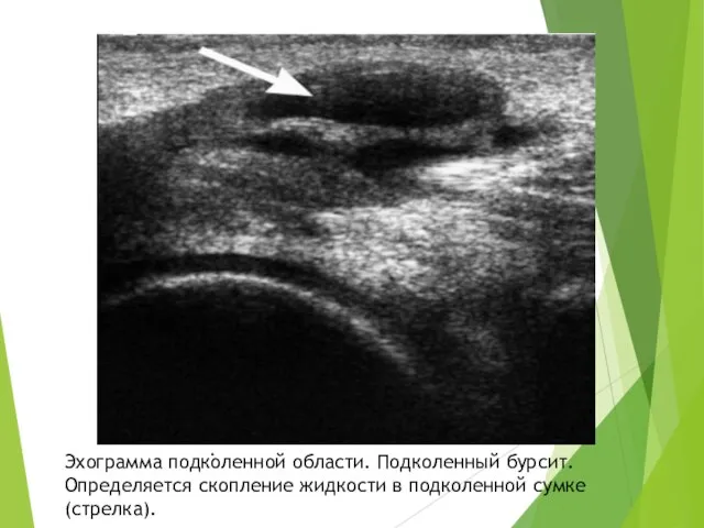 . Эхограмма подколенной области. Подколенный бурсит. Определяется скопление жидкости в подколенной сумке (стрелка).