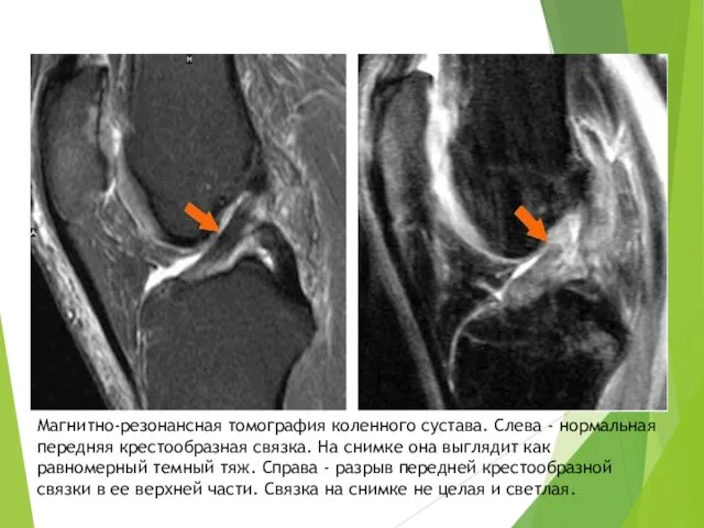 Магнитно-резонансная томография коленного сустава. Слева - нормальная передняя крестообразная связка. На