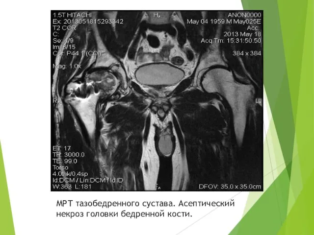 МРТ тазобедренного сустава. Асептический некроз головки бедренной кости.