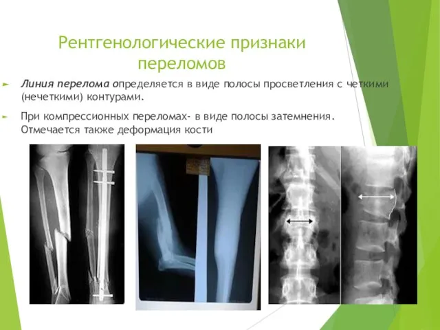 Рентгенологические признаки переломов Линия перелома определяется в виде полосы просветления с