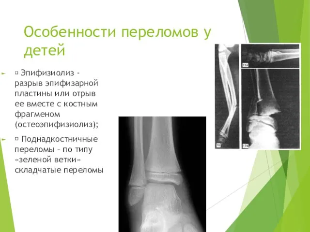 Особенности переломов у детей  Эпифизиолиз - разрыв эпифизарной пластины или