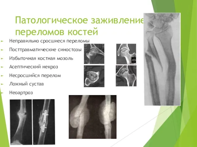 Патологическое заживление переломов костей Неправильно сросшиеся переломы Посттравматические синостозы Избыточная костная