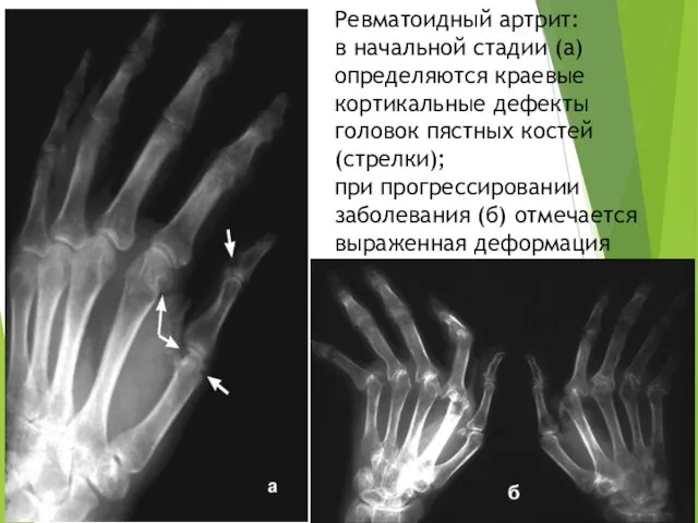 Ревматоидный артрит: в начальной стадии (а) определяются краевые кортикальные дефекты головок