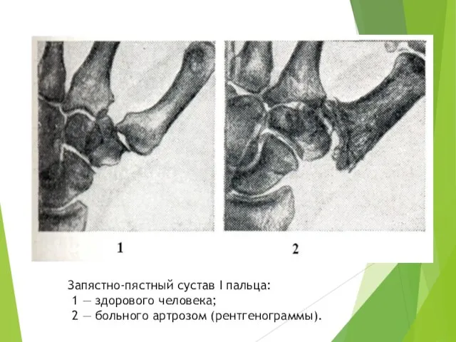 Запястно-пястный сустав I пальца: 1 — здорового человека; 2 — больного артрозом (рентгенограммы).