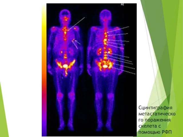 Сцинтиграфия метастатического поражения скелета с помощью РФП
