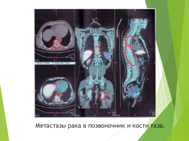 Метастазы рака в позвоночник и кости таза.