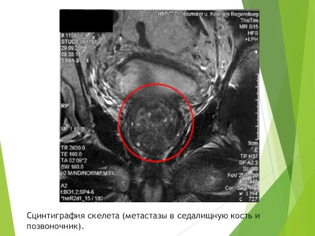 Сцинтиграфия скелета (метастазы в седалищную кость и позвоночник).