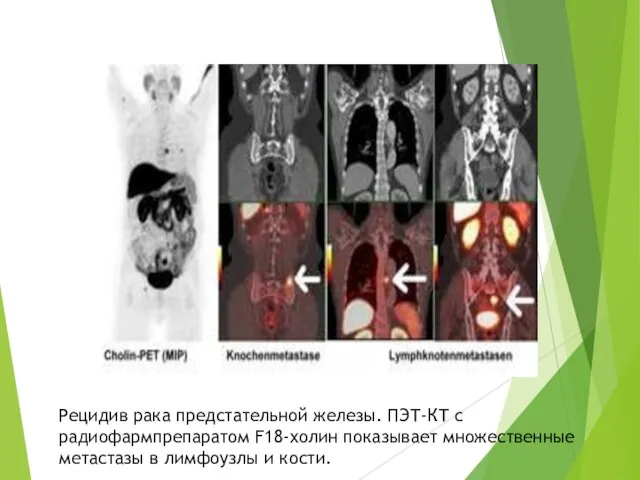 Рецидив рака предстательной железы. ПЭТ-КТ с радиофармпрепаратом F18-холин показывает множественные метастазы в лимфоузлы и кости.