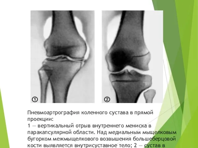 Пневмоартрография коленного сустава в прямой проекции: 1 — вертикальный отрыв внутреннего