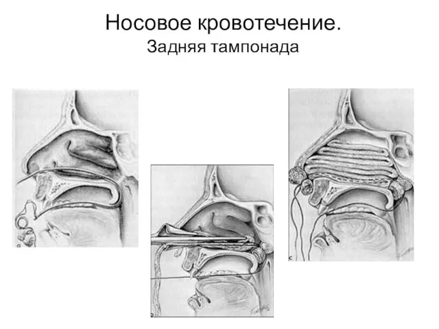 Носовое кровотечение. Задняя тампонада