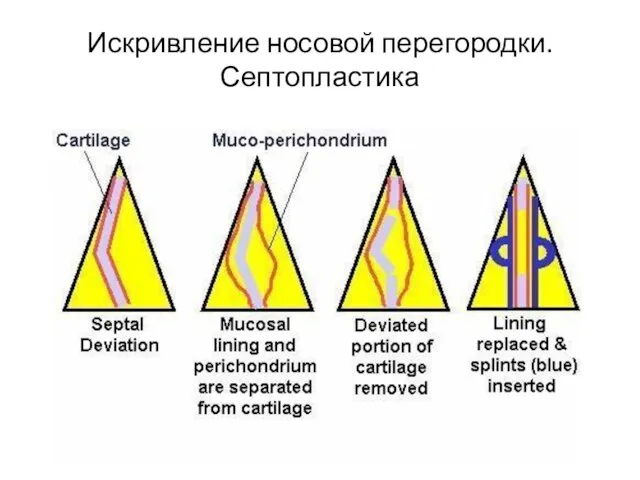 Искривление носовой перегородки. Септопластика