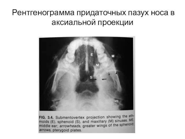 Рентгенограмма придаточных пазух носа в аксиальной проекции