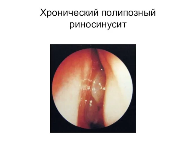 Хронический полипозный риносинусит