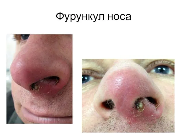 Фурункул носа