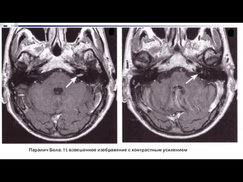 Паралич Бела. T1-взвешенное изображение с контрастным усилением