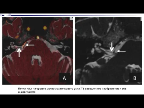 Петля AICA на уровне мостомозжечкового угла. Т2-взвешенное изображение + TOF-ангиограмма