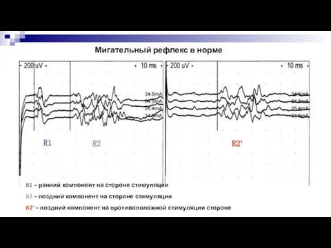 R1 – ранний компонент на стороне стимуляции R2 – поздний компонент