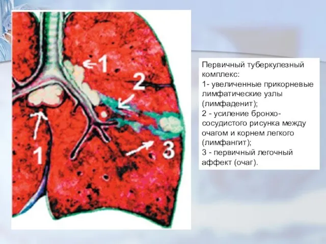 Первичный туберкулезный комплекс: 1- увеличенные прикорневые лимфатические узлы (лимфаденит); 2 -