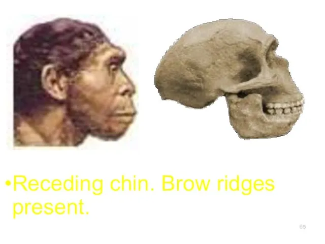 Receding chin. Brow ridges present.