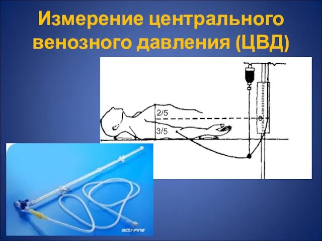 Измерение центрального венозного давления (ЦВД)