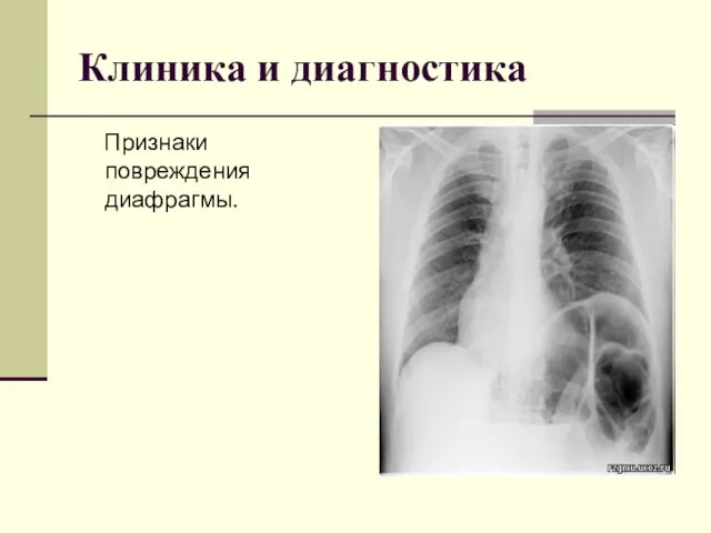 Клиника и диагностика Признаки повреждения диафрагмы.