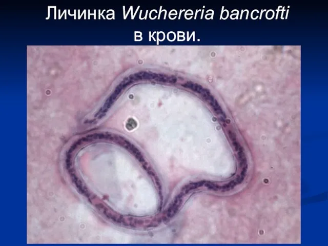 Личинка Wuchereria bancrofti в крови.