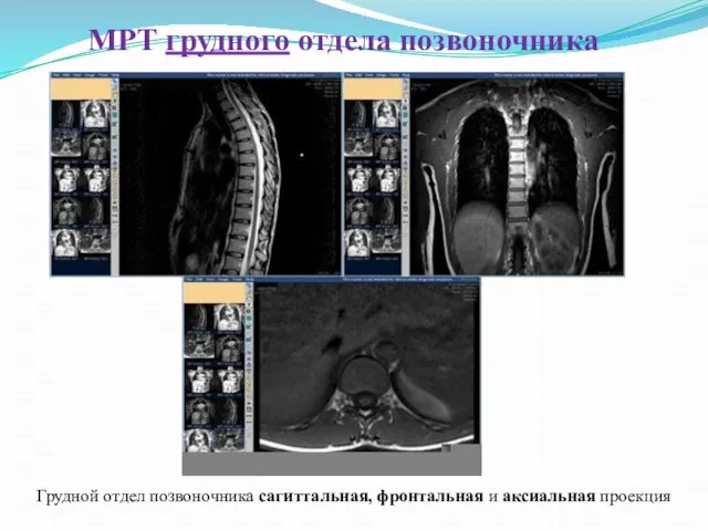 МРТ грудного отдела позвоночника Грудной отдел позвоночника сагиттальная, фронтальная и аксиальная проекция