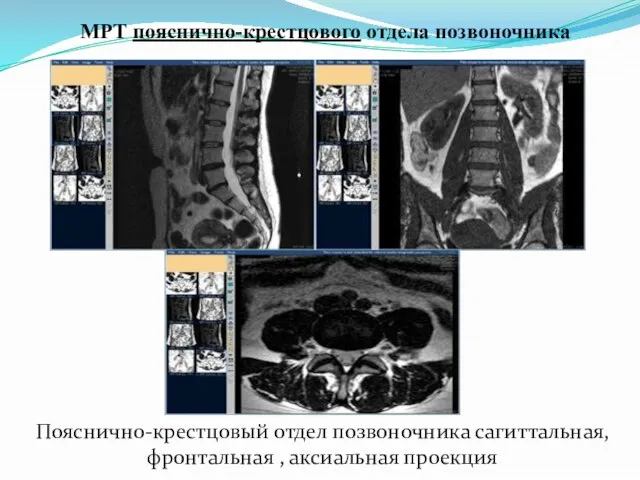 МРТ пояснично-крестцового отдела позвоночника Пояснично-крестцовый отдел позвоночника сагиттальная, фронтальная , аксиальная проекция