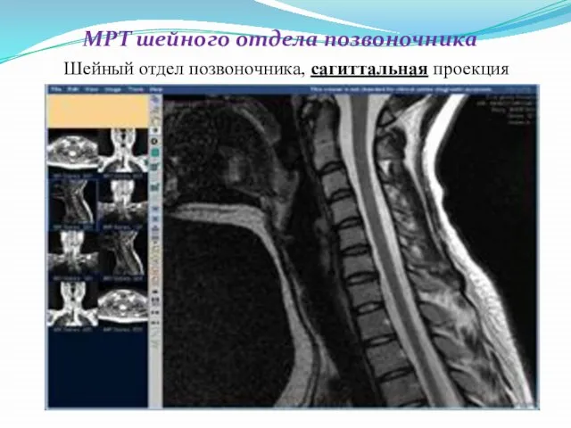 МРТ шейного отдела позвоночника Шейный отдел позвоночника, сагиттальная проекция