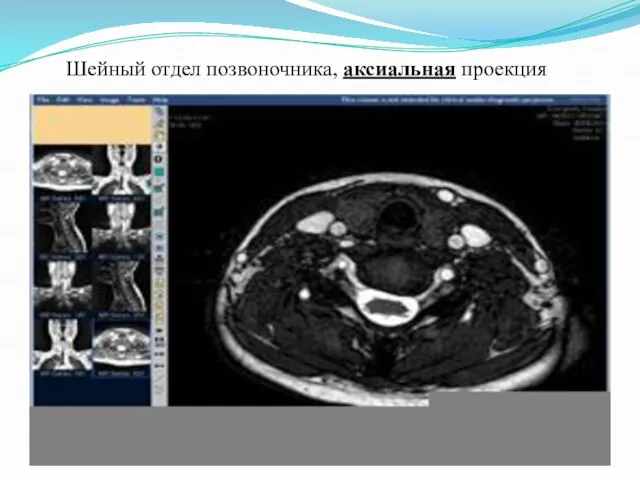 Шейный отдел позвоночника, аксиальная проекция